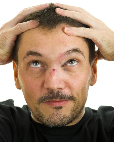 Man with crooked, broken nose und black eye — Stock Photo, Image