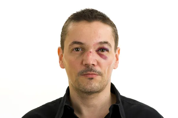 stock image Man with broken, crooked nose and black eye