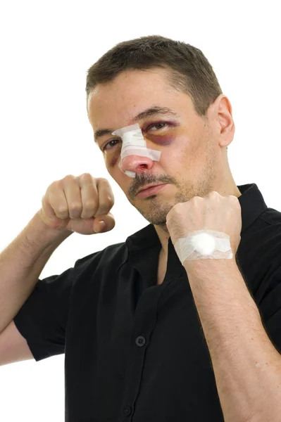 Nasenbeinbruch nach Operation — Stockfoto