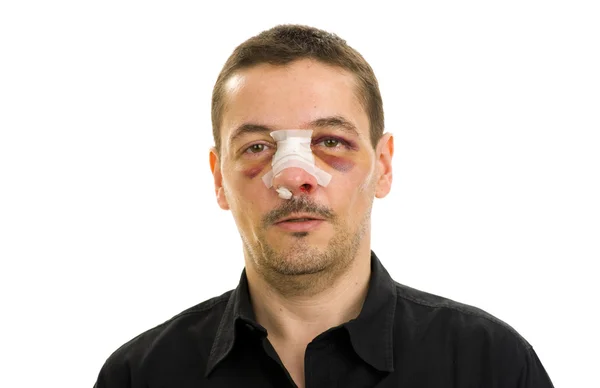 Zlomený nos a černé oči — Stock fotografie