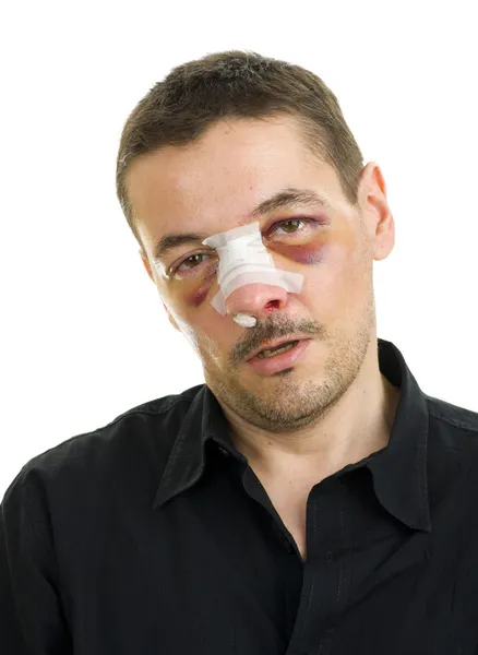 Złamany nos po operacji — Zdjęcie stockowe