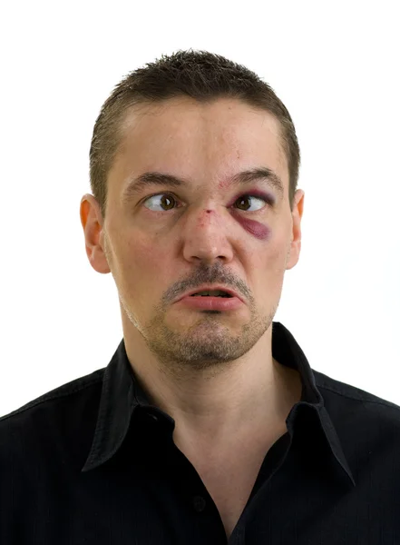 Złamane, Krzywy nos i czarny, skrzyżowane oczy — Zdjęcie stockowe