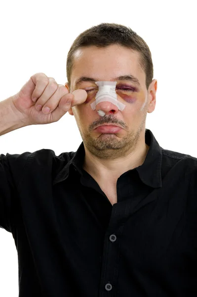 Операция сломанного носа — стоковое фото