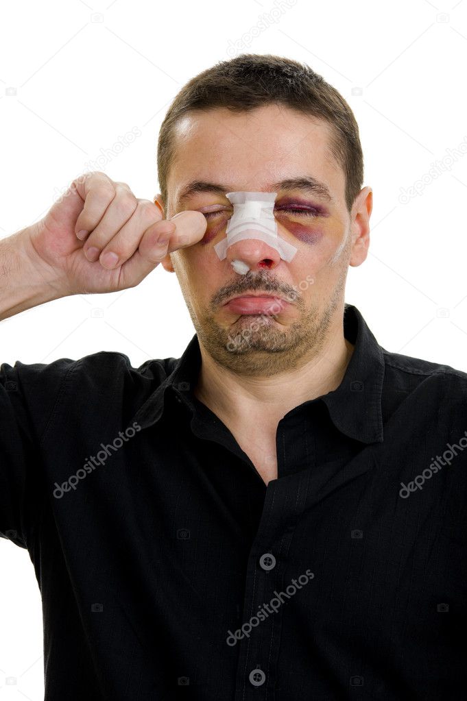 Broken nose post operation