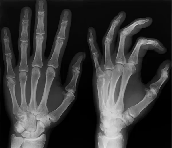 Röntgen vänster hand. — Stockfoto