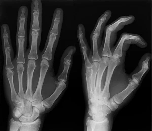 Röntgen der linken Hand. Stockbild