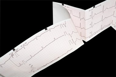 EKG grafiği