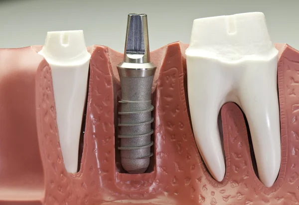 Diş implantı modeli — Stok fotoğraf