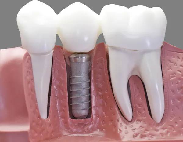 Afgetopte dental implant model — Stockfoto