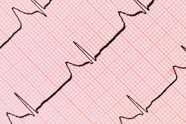 EKG grafiği