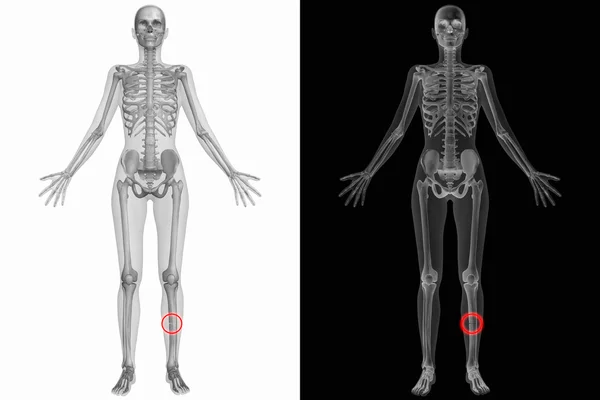 人体解剖学-断左的胫骨 — 图库照片