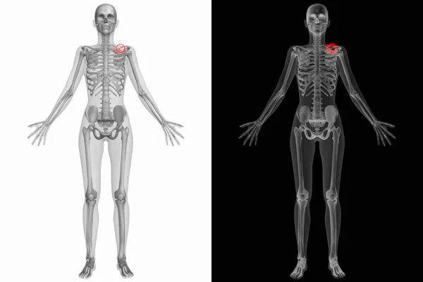 Человеческая анатомия - сломанная левая ключица — стоковое фото