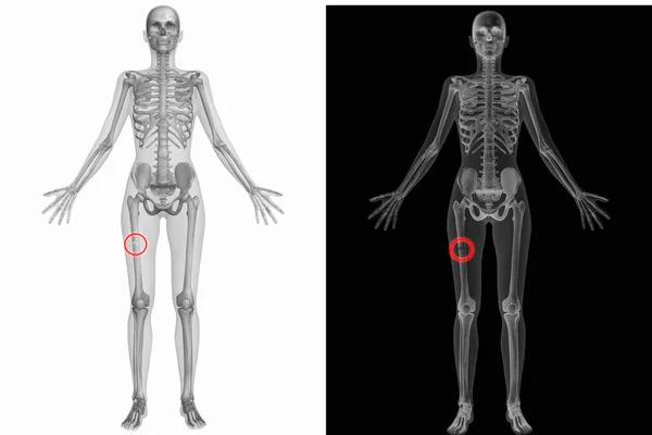 Anatomía humana - Fémur derecho roto — Foto de Stock