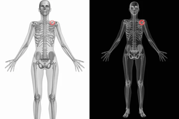Människans anatomi - brutit vänster skulderblad — Stockfoto