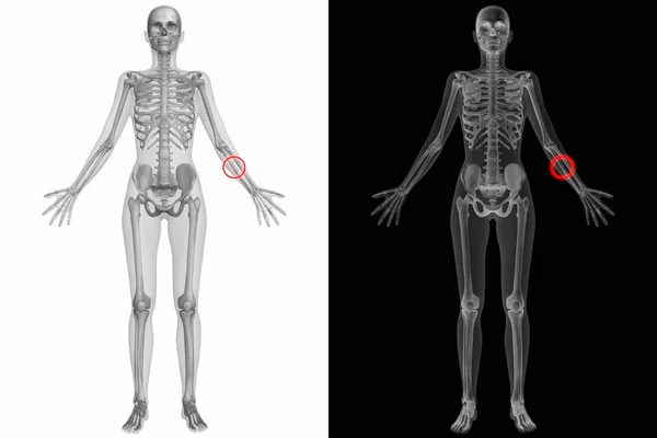 Insan anatomisi - sol dirsek kemiği kırık — Stok fotoğraf