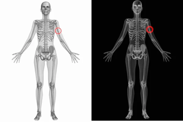 Insan anatomisi - sol kol kemiği kırık — Stok fotoğraf