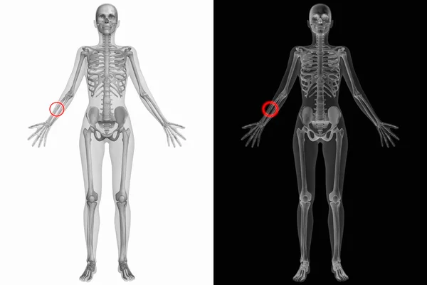 Anatomie člověka - rozbité pravé poloměr — Stock fotografie